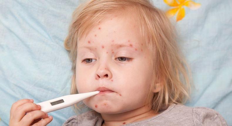 ___3935802___https:______static.pulse.com.gh___webservice___escenic___binary___3935802___2015___7___3___16___Sick-child-with-the-measles-Shutterstock-800x430