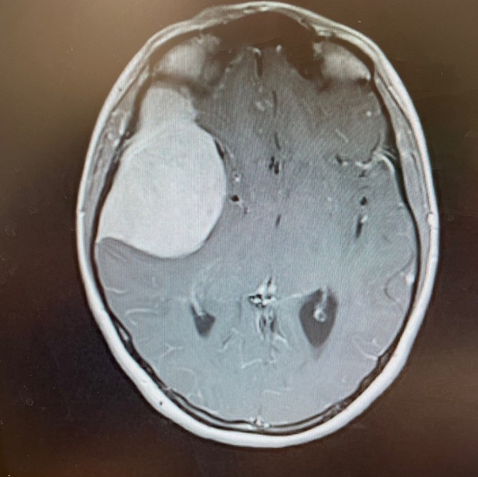 Tumor koji je otkriven bio je veličina gejpfruta