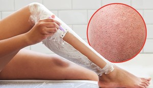 Korišćenje starog ili tupog brijača može da izazove kvržice od brijanja