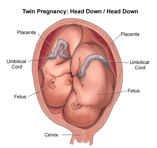 What are the factors responsible for a multiple pregnancy? - Image: Summa Health