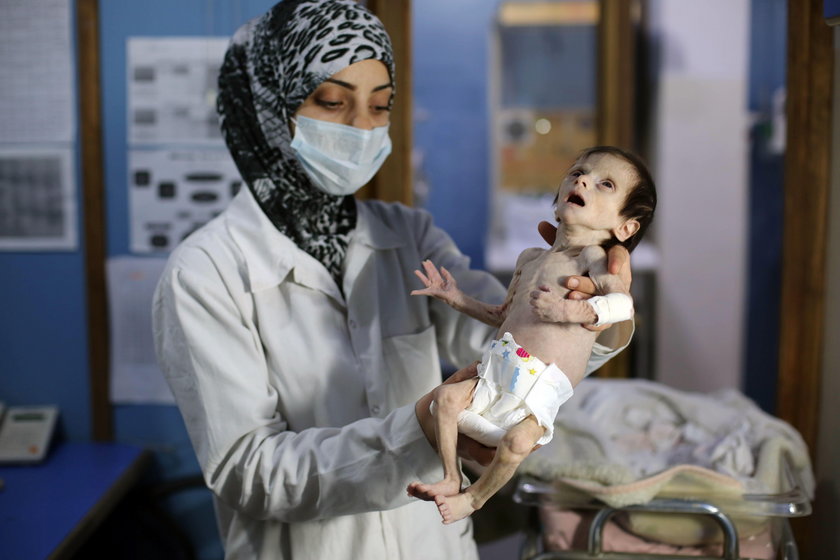 Wstrząsające zdjęcie zagłodzonego niemowlęcia w Syrii obiegło świat