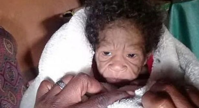 une jeune femme donne naissance à un enfant atteint de progeria