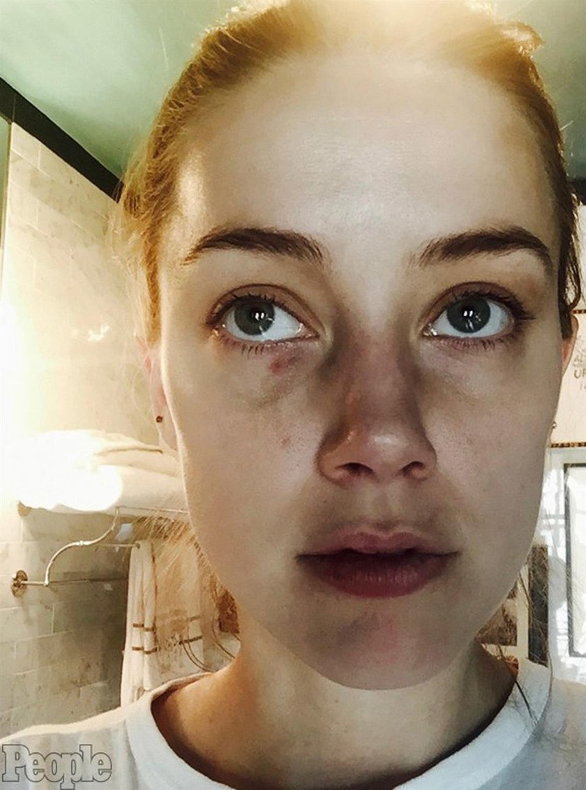 Amber Heard ze śladami pobicia