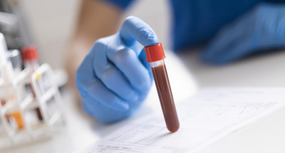 Przygotowanie do badań krwi. Jak się odpowiednio przygotować do pobrania  krwi?