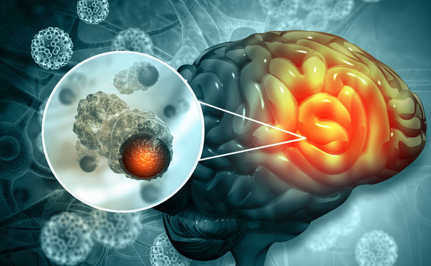 Nowy lek opóźnia rozwój glejaka, śmiertelnego nowotworu mózgu