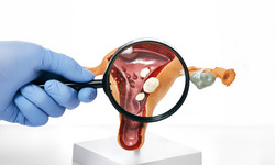 Polipy macicy - objawy, diagnostyka, leczenie. Jak rozpoznać polipy macicy?