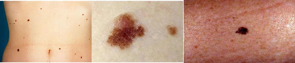 Desplastični nervusi