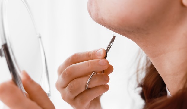 Višak androgena vodi do ozbiljnih metaboličkih, reproduktivnih i psihičkih problema kod žena