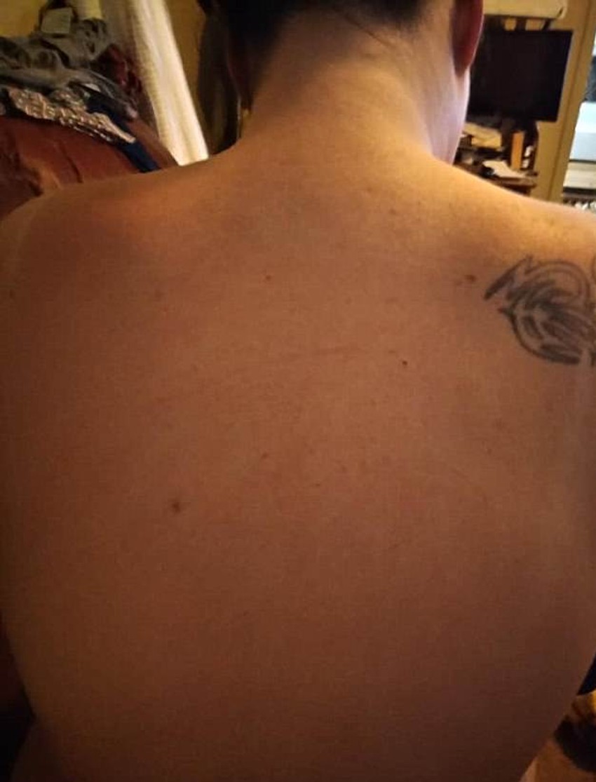 Sindina koža nakon korišćenja pene za brijanje