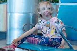 Rođena je BEZ VILICE I USTA, porodica je se ODREKLA jer nije mogla da je gleda, a ovo je ONA DANAS: Svi zapanjeno gledaju kako izgleda "devojčica sa pola lica" i dive se roditeljima