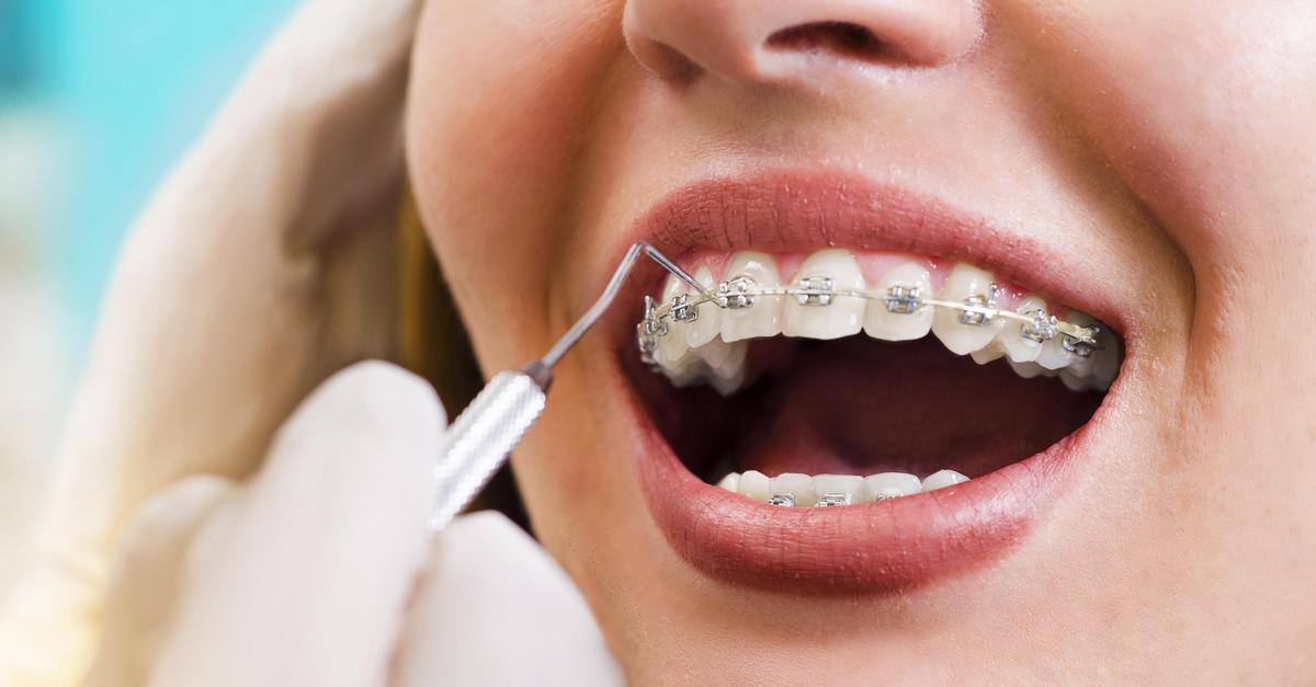Jak Przebiega Leczenie Ortodontyczne Krok Po Kroku