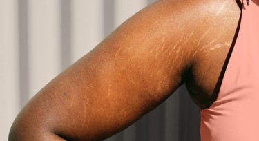 How to get rid of stretch marks for good scientifically