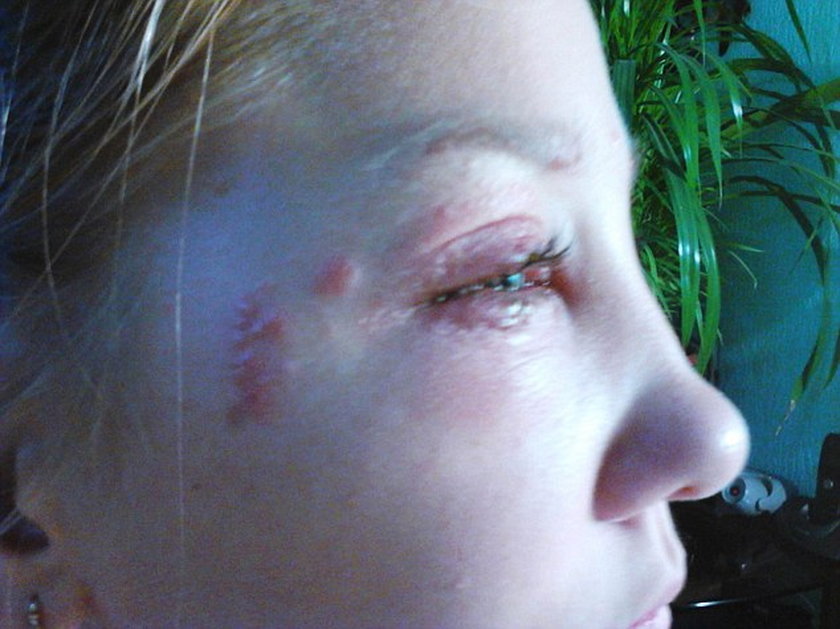 13-latka oślepła przez kosmetyczkę