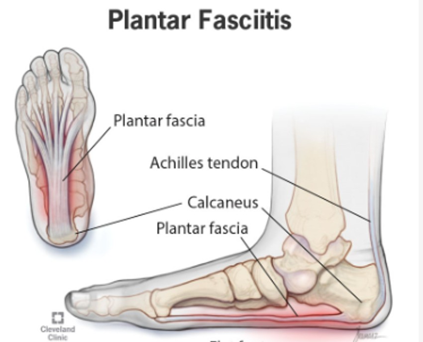 Ravni tabani ili visoki svod stopala povećavaju rizik od plantarnog fascitisa