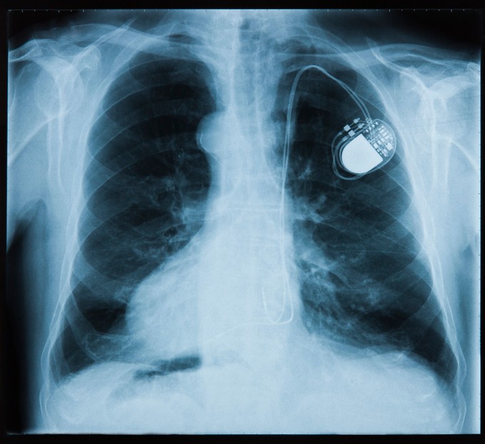 Pacemaker, defibrillátor beültetése: ezekben az esetekben szükséges