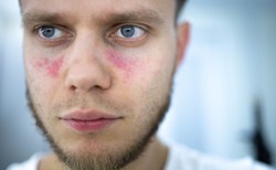 Toczeń rumieniowaty układowy - od objawów po leczenie