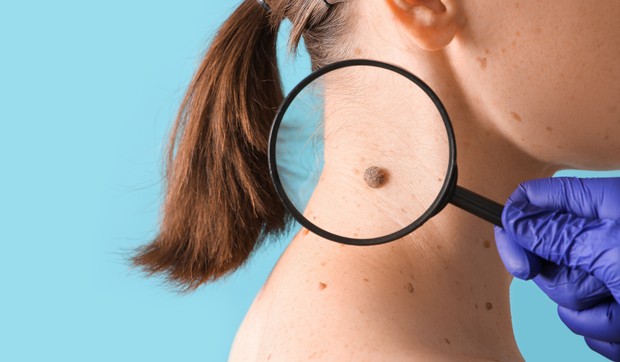 Određene karakteristike mladeža mogu da ukazuju na melanom