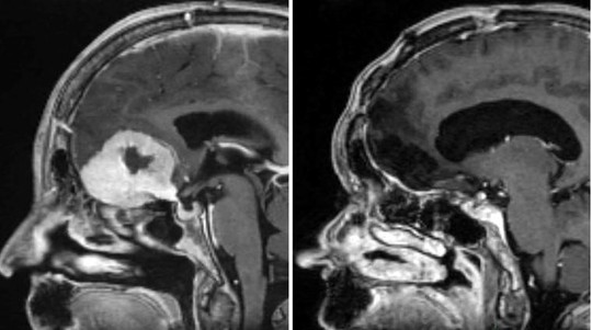 Snimak tumora na mozgu (levo) i nakon uklanjanja (decno)