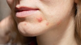 ¿Fatiga, cambios de humor, imperfecciones en la piel?  ¡Descubre si tu cuerpo tiene deficiencia de vitamina B!