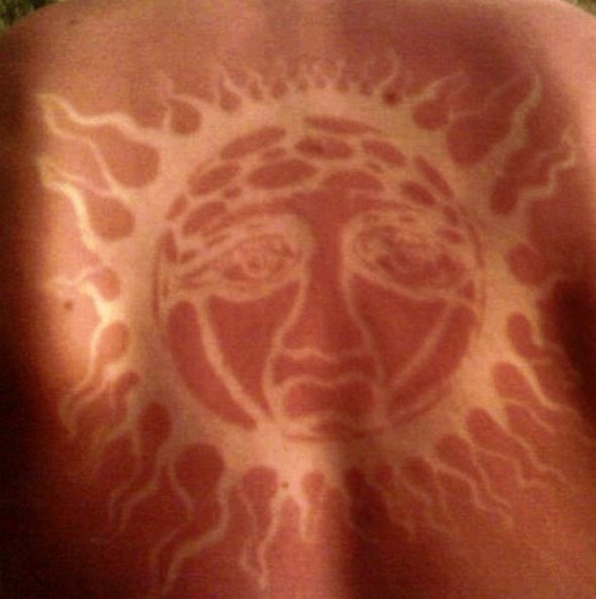 Sunburn Art