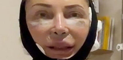 65-letnia Nina zoperowała sobie twarz w Turcji. Pokazała efekt i mówi, czy żałuje