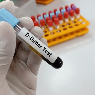 Mit jelent a D-dimer érték a laborleleten?
