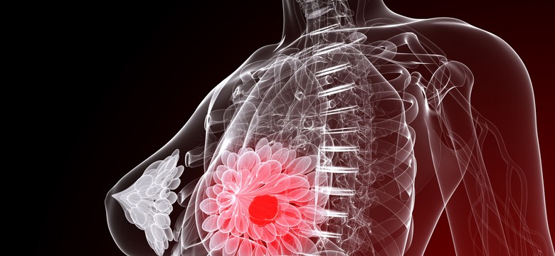 Czy profilaktyczna mastektomia jest możliwa w Polsce?
