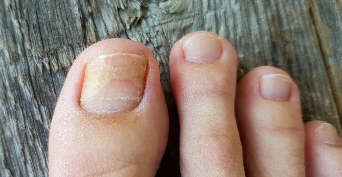 Onycholiza paznokcia - objawy i leczenie choroby