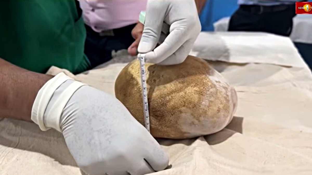 Lekari uspešno su uklonili kamen iz bešike težak 3,1 kg, što je najteži poznati slučaj u medicinskoj istoriji