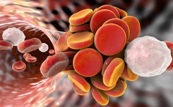 Żylna choroba zakrzepowo-zatorowa zbiera tragiczne żniwo. OBJAWY