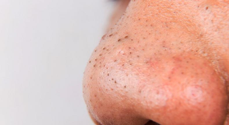 Blackheads are caused by oils and dead skin cells