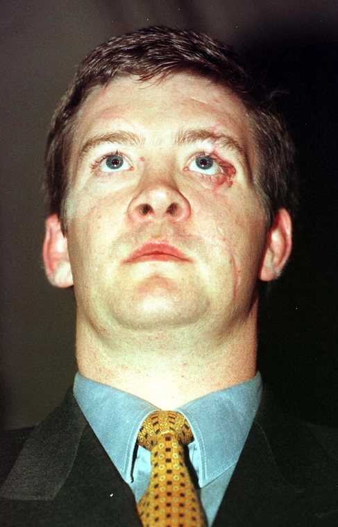 Trevor Rees-Jones w 1997 r. po wyjściu ze szpitala. Na jego twarzy widać blizny 