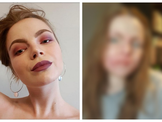 Celo lice joj je izgorelo u požaru, a najviše se plašila da je dečko ne ostavi