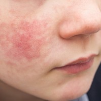 Rózsahimlő, skarlát vagy lepkehimlő? Így különböztesse meg a kiütéses betegségeket
