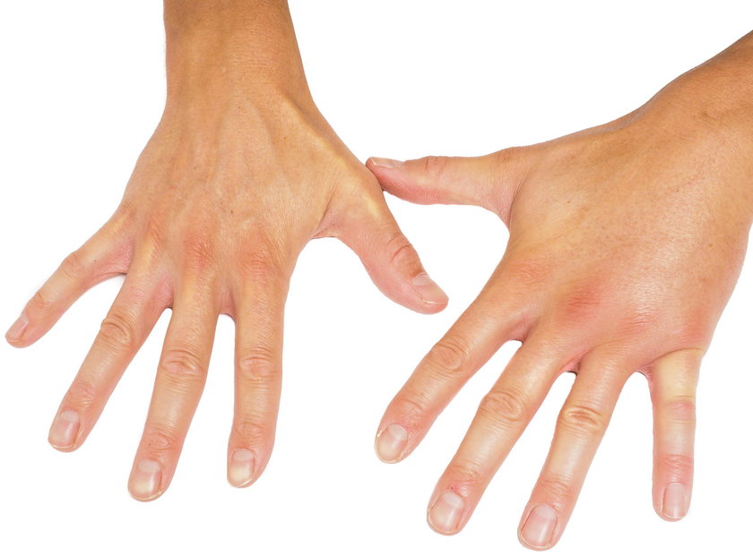 Obrzęk palców dłoni występuje najczęściej w okolicy stawów i może sugerować chorobę reumatyczną lub zwyrodnieniową. 