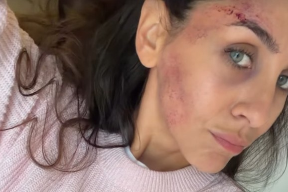 IVANI DUDIĆ LICE U PODLIVIMA I OGREBOTINAMA Glumica doživela nezgodu, otkrila šta joj se desilo (FOTO)