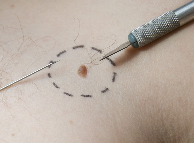 Czynnik ryzyka czerniaka