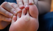 Brodawki na stopie - rodzaje i przyczyny zakażenia