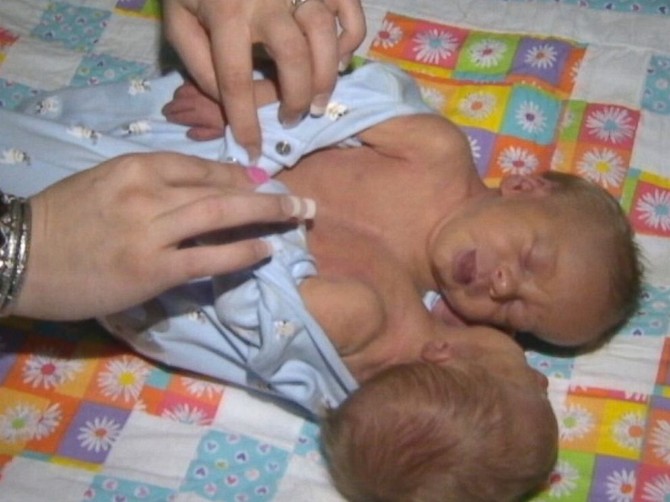 59693_abc-conjoined-twins-1-sr-140425-4x3-992