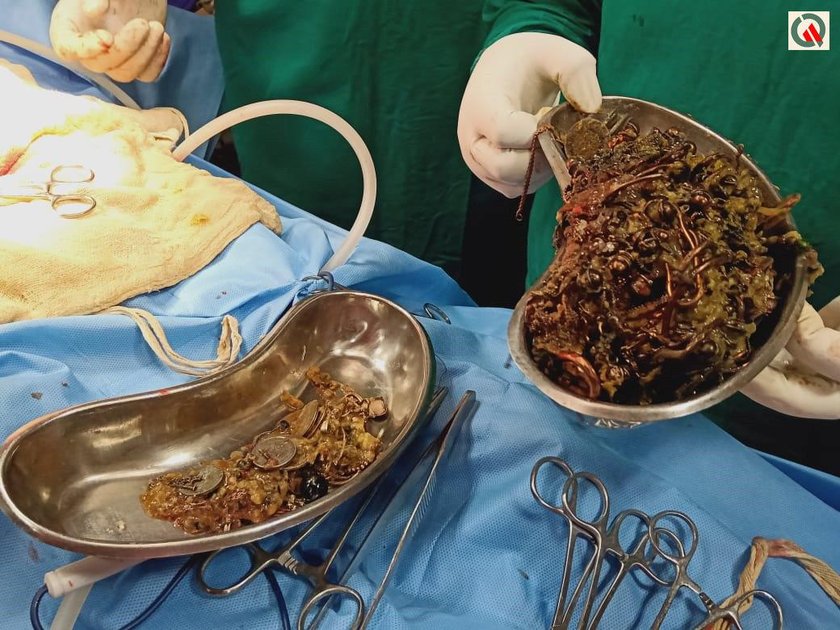 Wyciągnęli z brzucha Runi Khatun 1,6 kg biżuterii