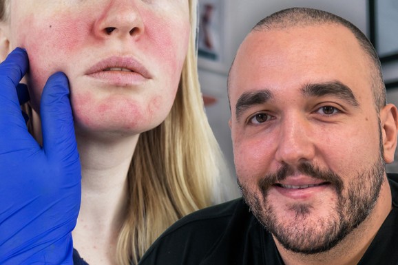 Rozacea - uporno crveni obrazi i kapilari koji ne prolaze: D