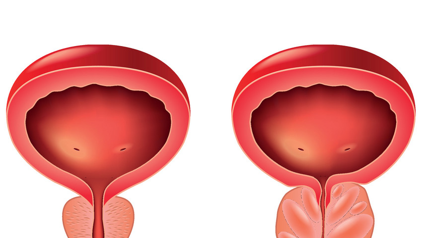 prostatitis és nyaralás)