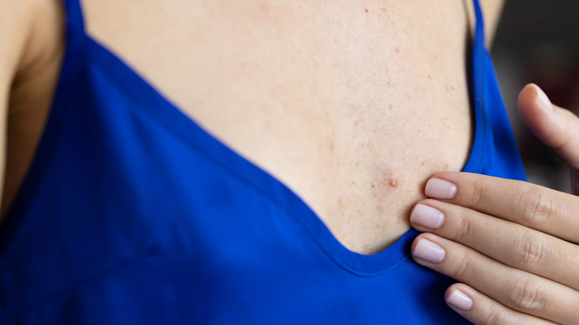 Dermatolog o krostkach na piersiach. Natychmiast odstaw popularny produkt