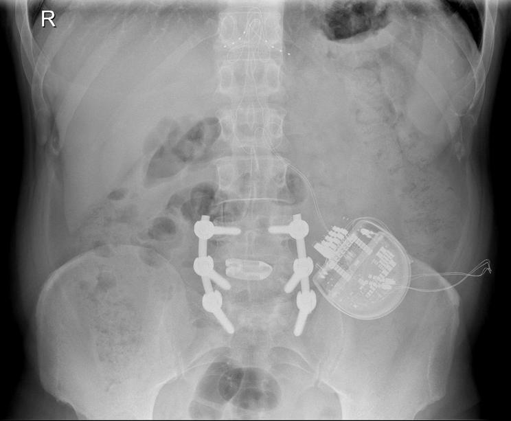 A röngenfelvételen látható a gerincprotézis és a fájdalmat kontrolláló gerinc-pacemaker