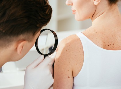 Basalioma, melanoma, spinalioma: ezek a 3 leggyakoribb bőrrák korai tünetei című cikk nyitóképe