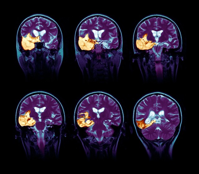 Majk sada želi da podigne svest ljudi o opakoj bolesti