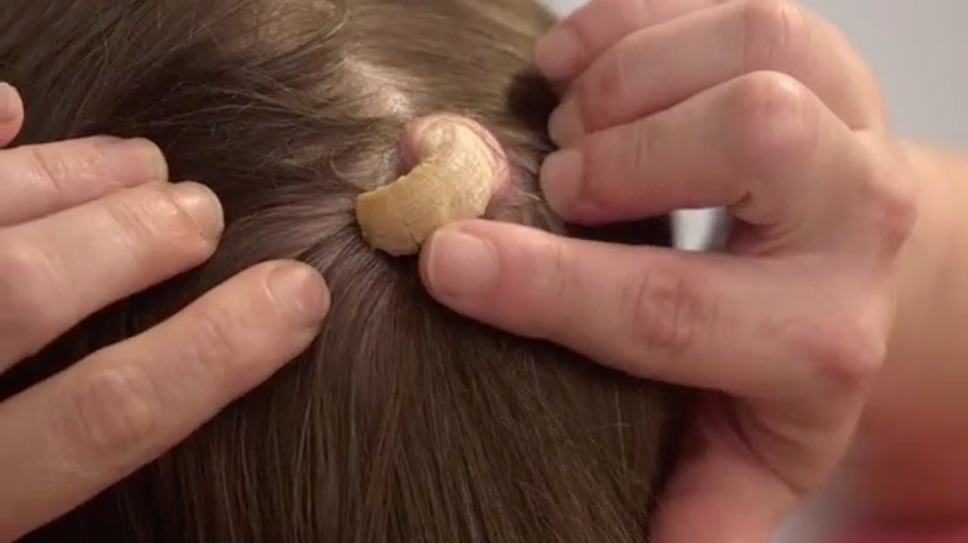 Dr. Pimple Popper treated a woman with a painful 'horn' growing on the back of her head Pulse