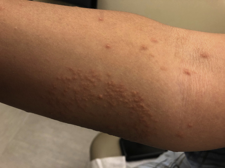 Eruptive xanthomatosis / fot. Mayo Clinic Proceedings