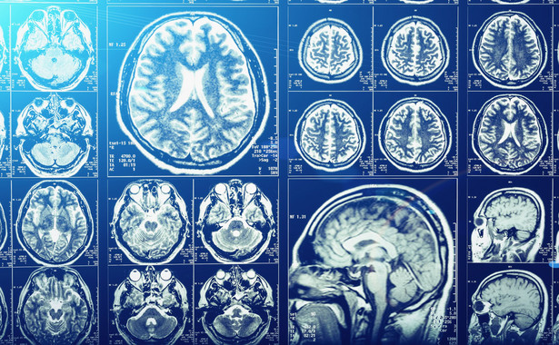 Obraz tomografii mózgu