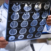 Nem javasolják az EU-ban az Alzheimer-kór elleni gyógyszer forgalomba hozatalát